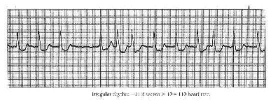 Calculate irregular heart rate
