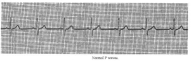 Normal P waves