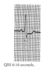 QRS Interval