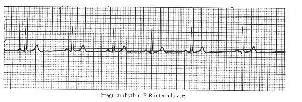 Irregular rhythm