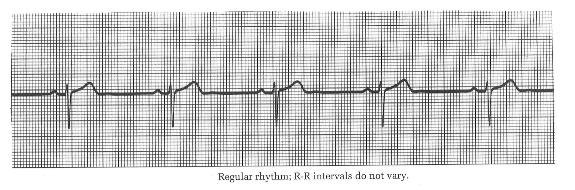 Regular rhythm