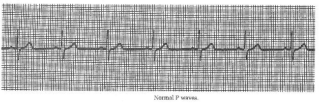 Normal P waves