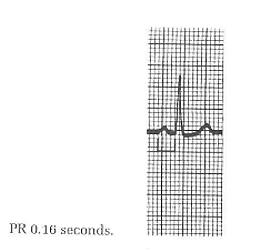 PR Interval